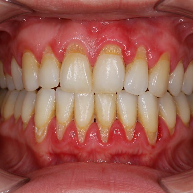 Valerie Y., 47 — gums and teeth before DentaPro