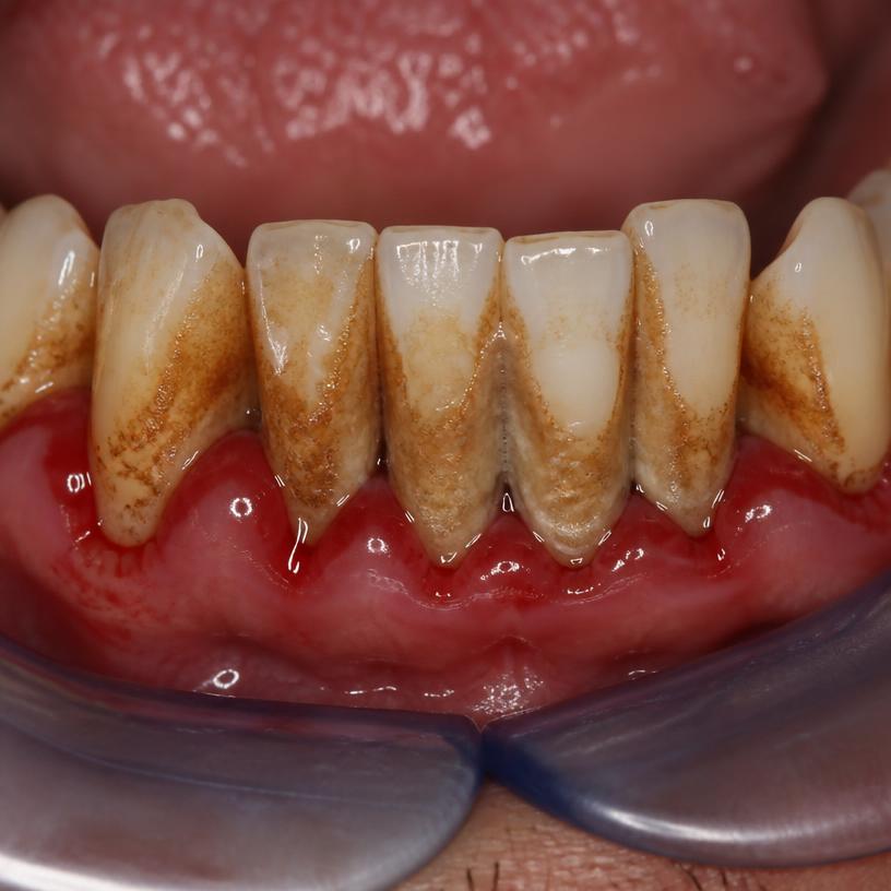 Marcus D., 52 — gums and teeth before DentaPro
