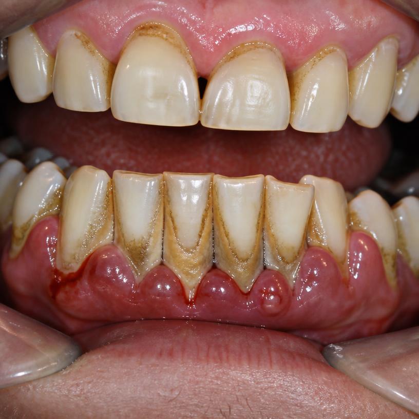 Priya S., 44 — gums and teeth before DentaPro