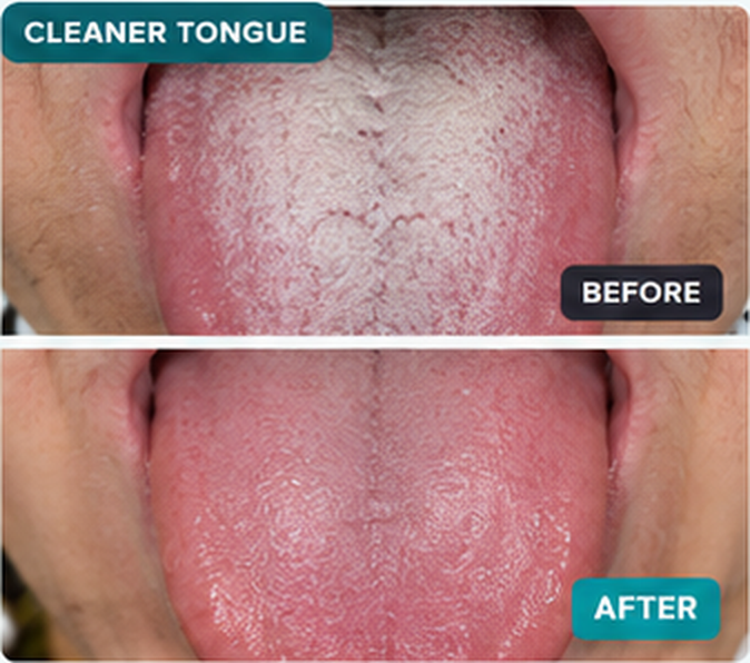 DentaPro before and after — Cleaner tongue