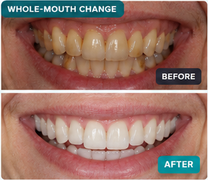 DentaPro before and after — Whole-mouth change